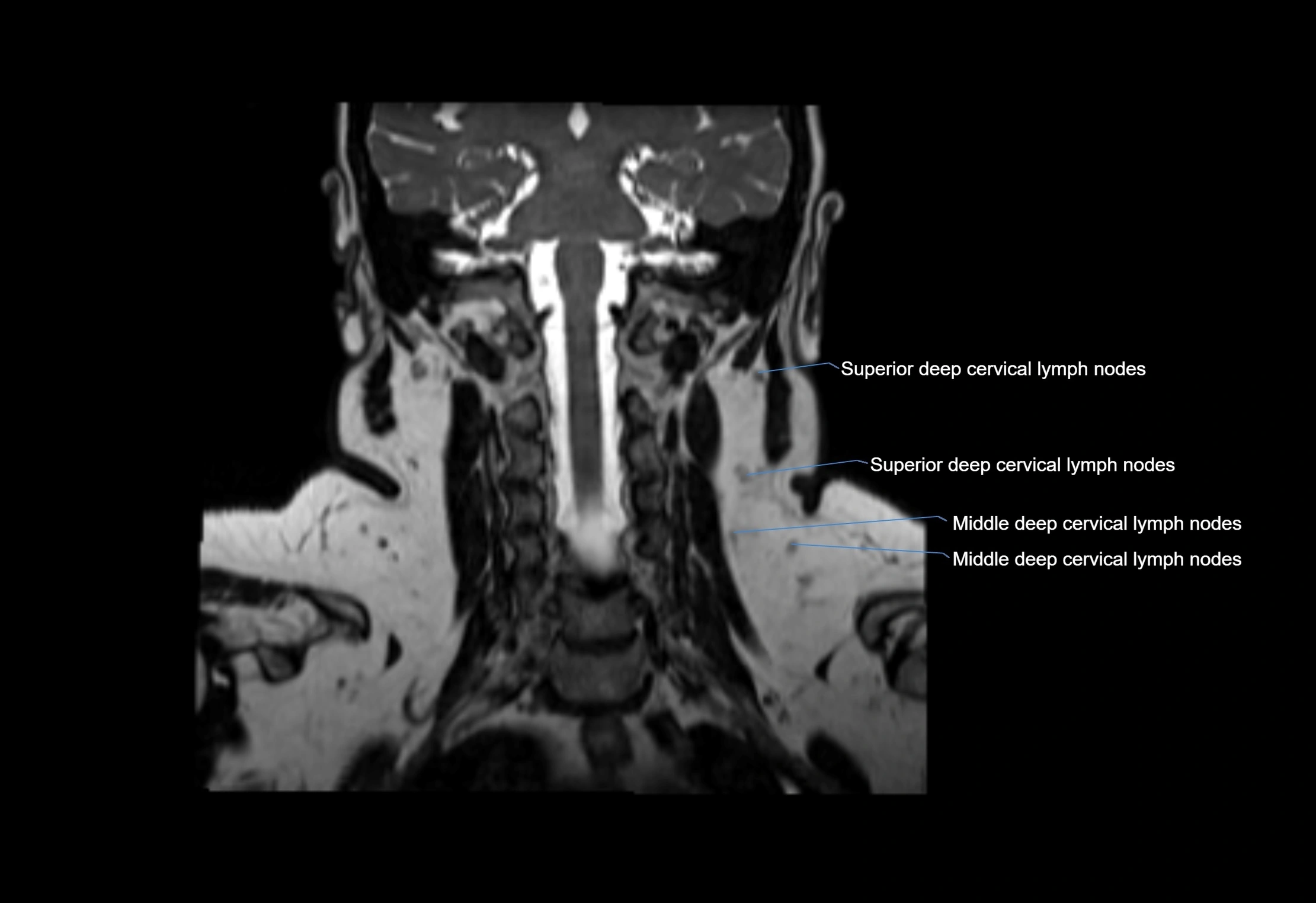 Neck coronal lymph node cross sectional MRI anatomy 3T MRI  image-img-00001-00025.webp